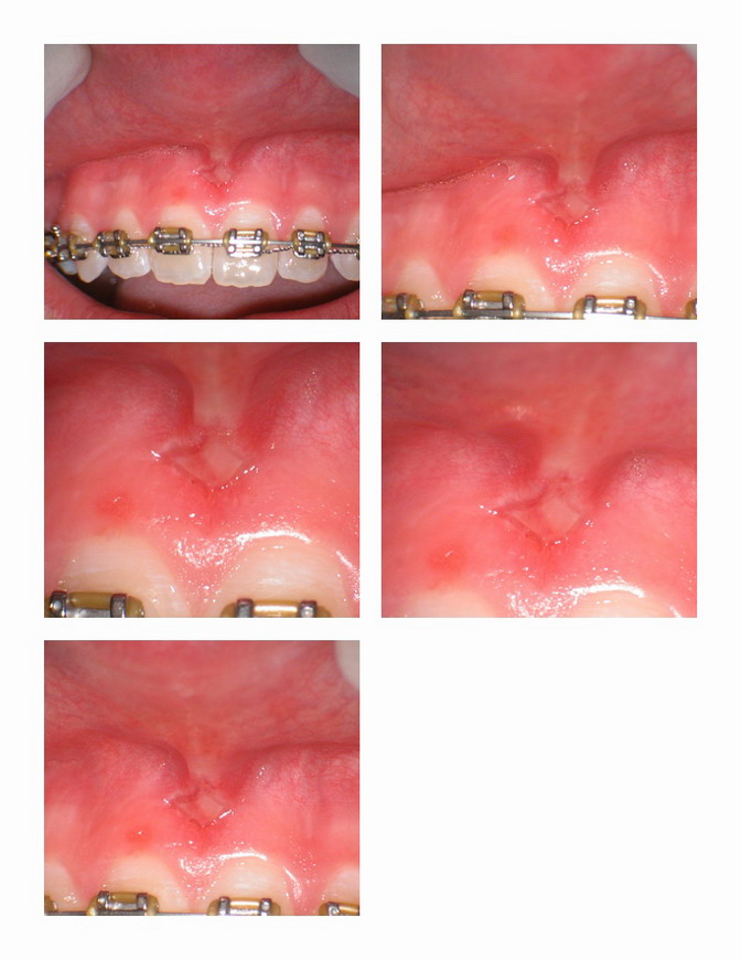 Healing 5 days on Frenectomy.jpg